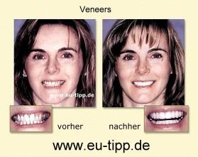 ZAHN-Reise CZ -günstiger als Ungarn- Implantate ab 490 Euro