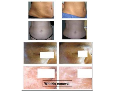Fett- Cellulite- Falten- Entfernung